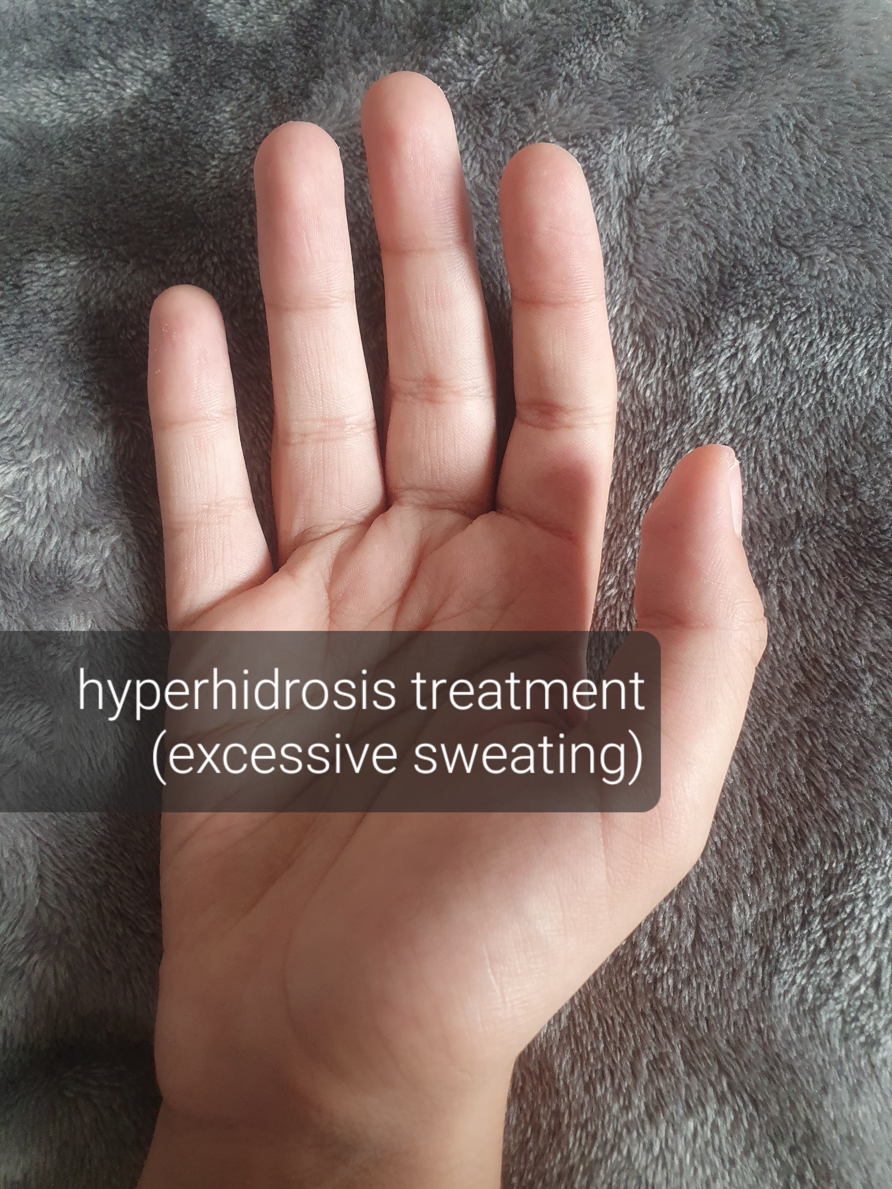 Hyperhidrosis treatment for excessive sweating